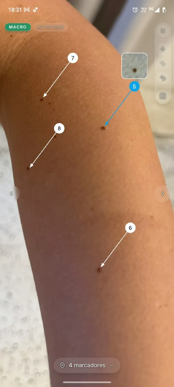 Imaginos screen: overview photo of an arm with numbered markers and the dermoscopy of one of them highlighted