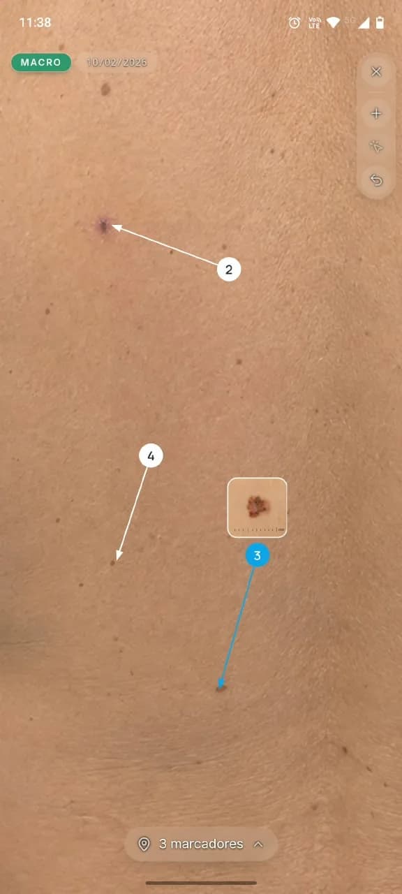 Markers. The same lesion, visit after visit.
