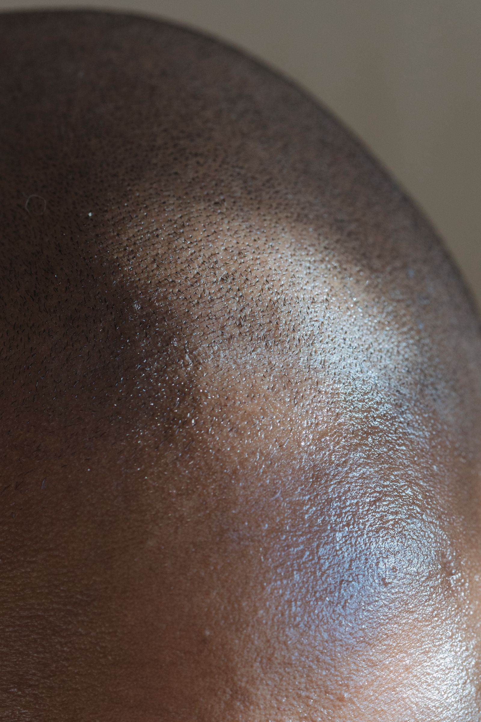 Close-up of a scalp with thinning hair, the starting point of a hair consultation